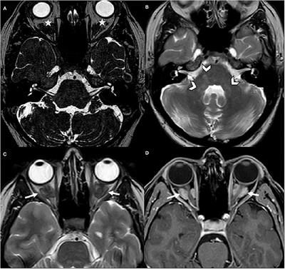 Erdheim-Chester Disease Revealed by Central Positional Nystagmus: A Case Report